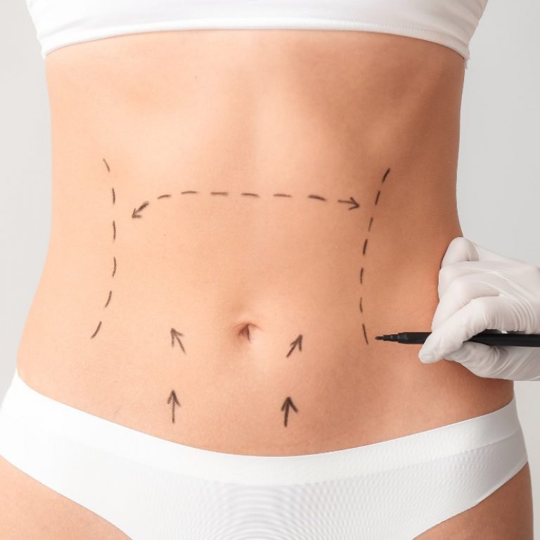 Abdominoplastia en Madrid Lab Vanitas