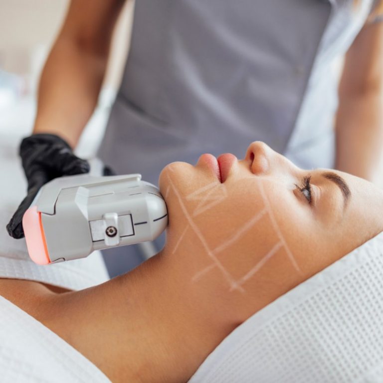 HIFU Facial en Madrid Lab Vanitas