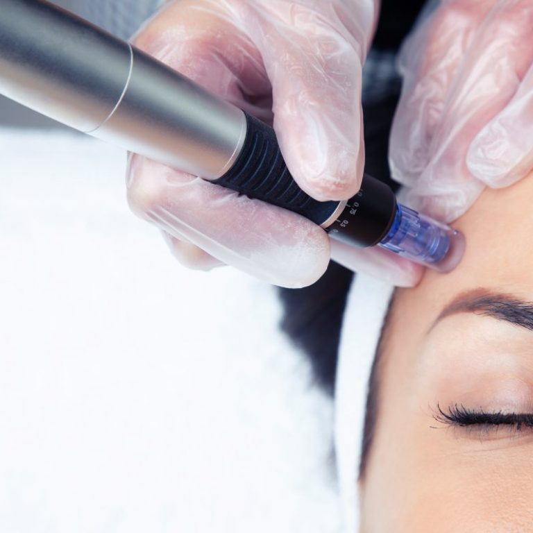 MICRONEEDLING en Madrid Lab Vanitas